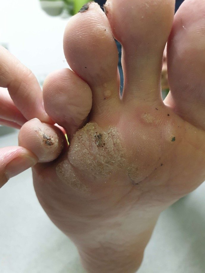 Adam Smith Podiatry Verruca