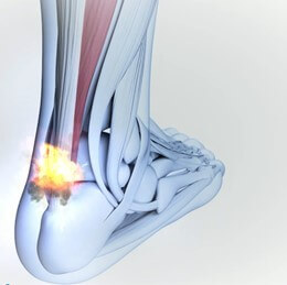 Do you have heel pain? It might be Achilles Tendinopathy