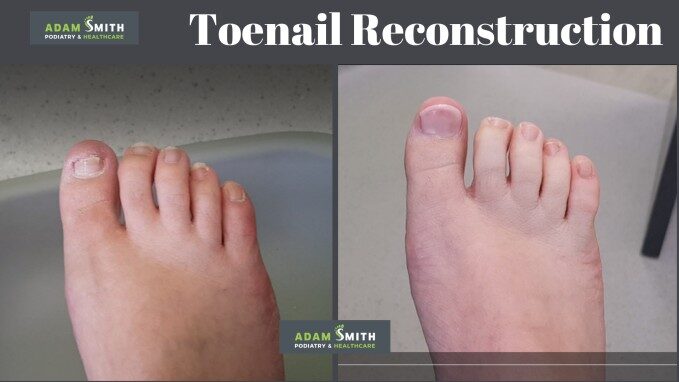 Toenail Reconstruction